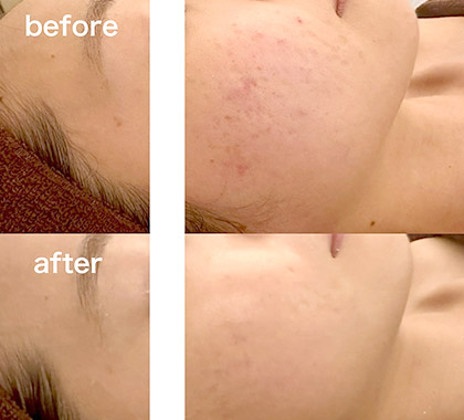 炎症の赤み/クレーター改善