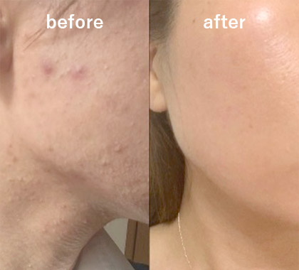 アレルギー・ニキビ肌