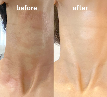 炎症、赤み、かゆみ