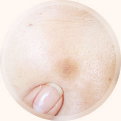 肌のくすみ・ざらつき