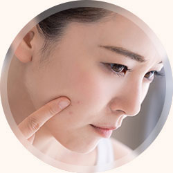 ニキビ・ニキビ跡